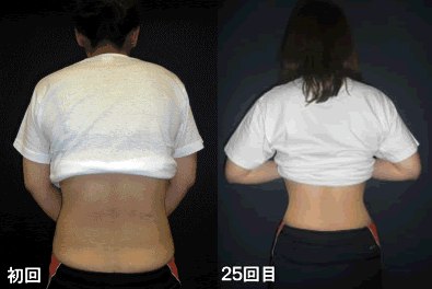 背中の変化の比較写真。左が初回、右が25回目